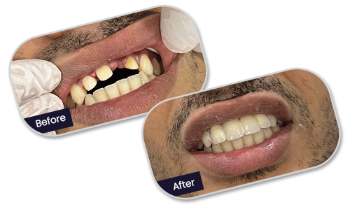 Dental implants Before After in turkey